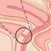 vesicovaginal fistula